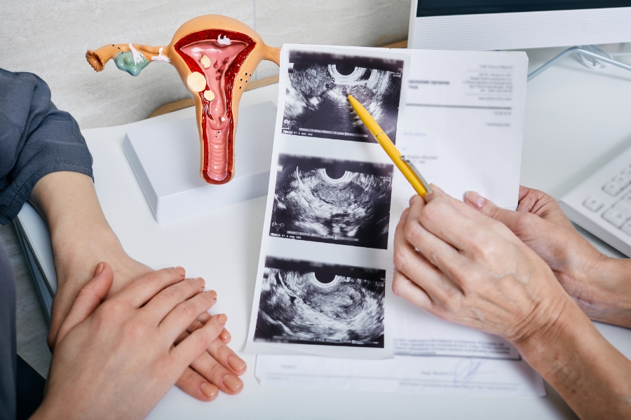 علاج تكيس المبايض للمتزوجة