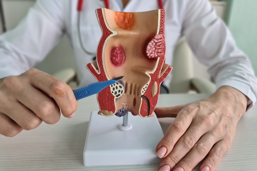 متى أستطيع الجلوس بعد عملية الناسور