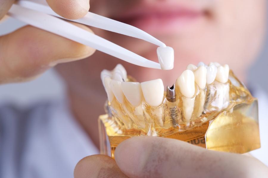 تجارب زراعة الاسنان في الرياض