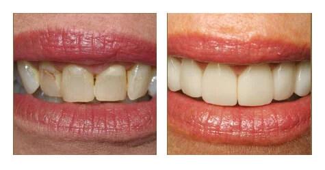 Are Veneers for You?