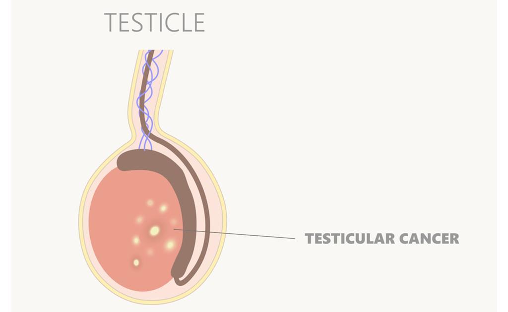 6 Clinical signs of testicular cancer