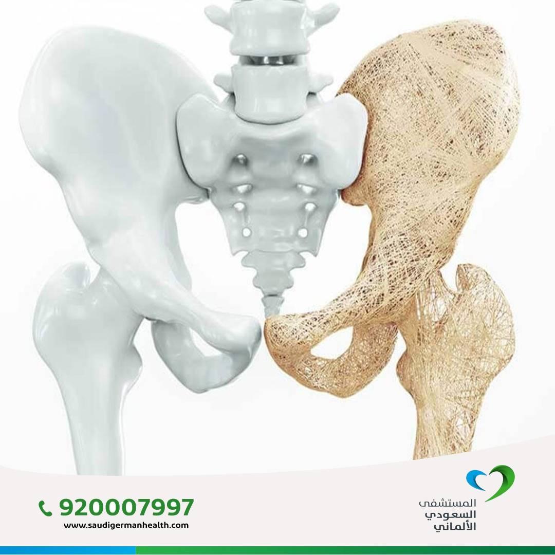 أفضل دكتور عظام بالرياض لعلاج هشاشة العظام