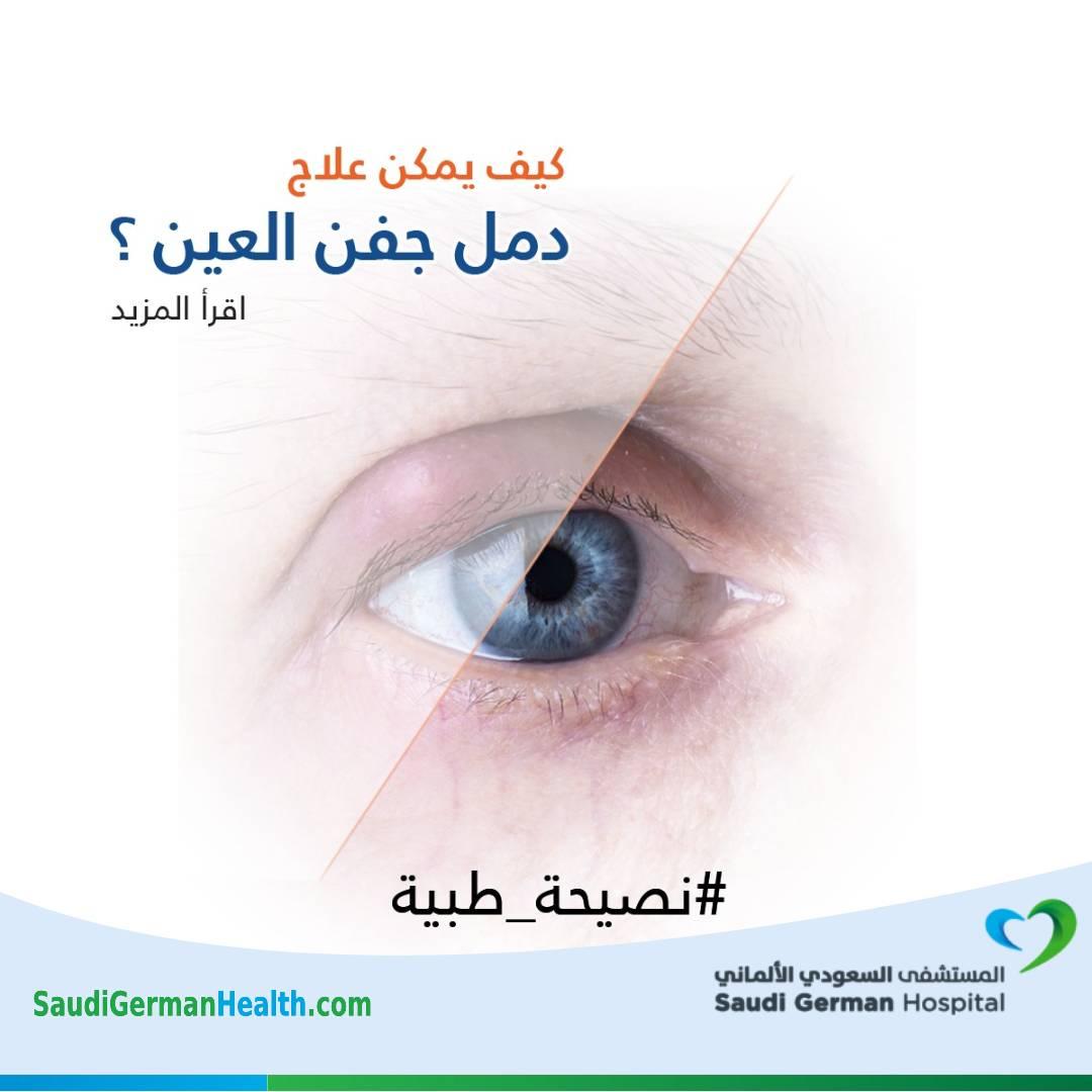 كيف يمكن علاج دمل جفن العين ؟