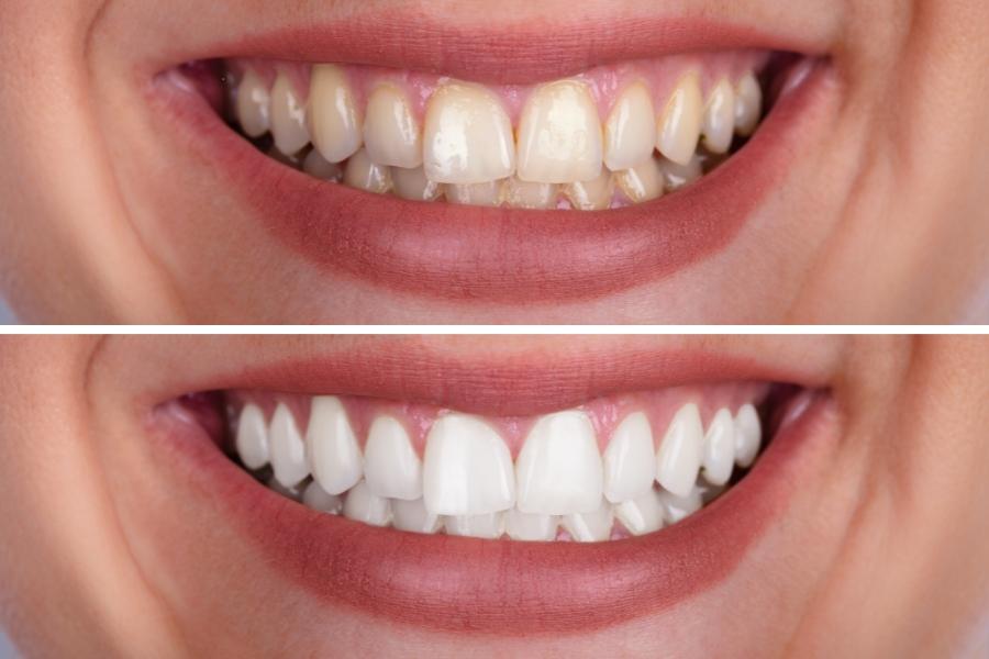 عروض ابتسامة هوليود الرياض