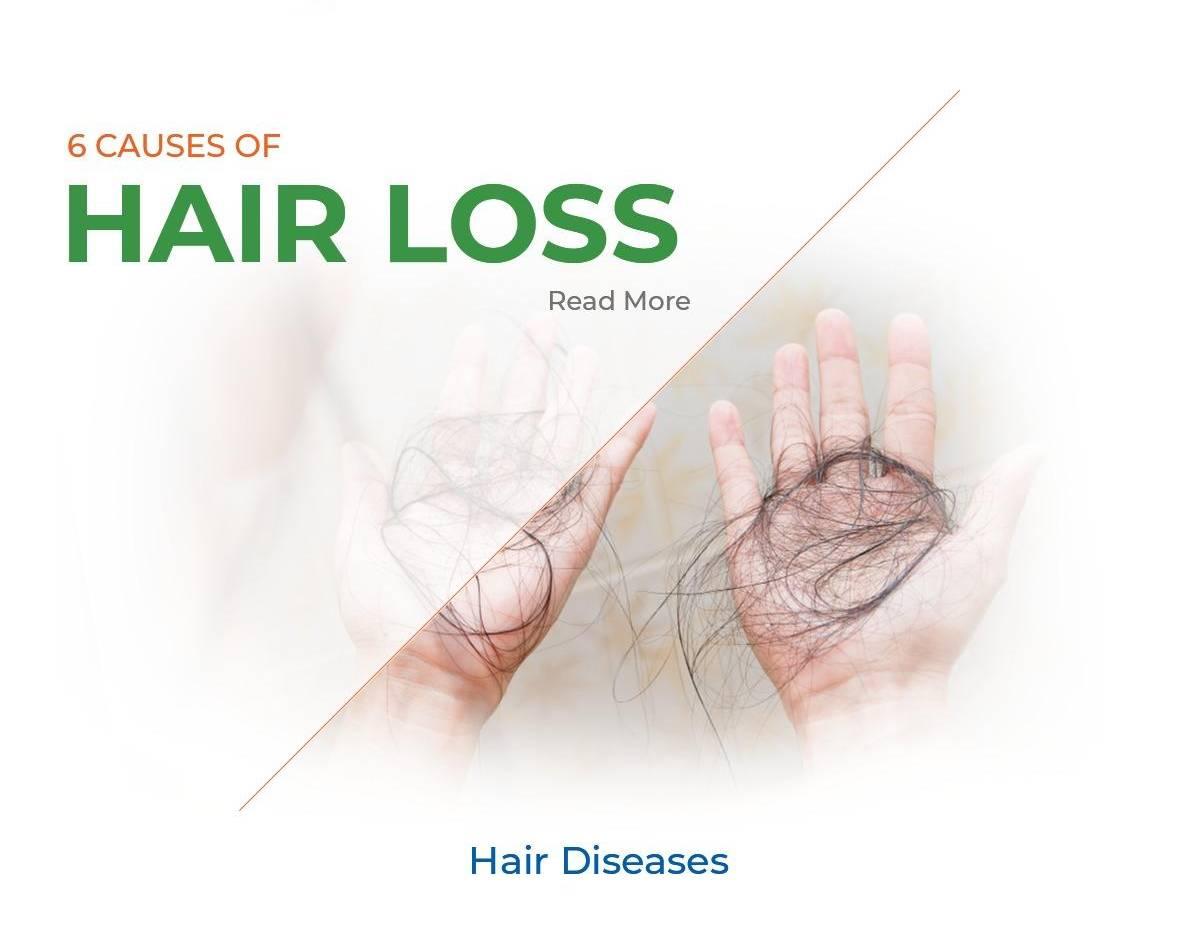 6 Causes of hair loss