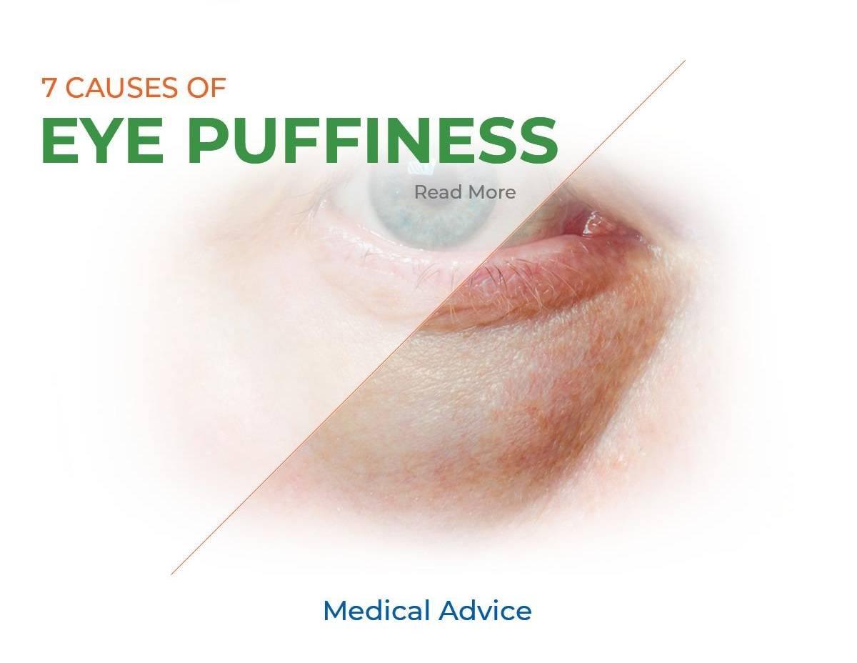 7 Causes of eye puffiness