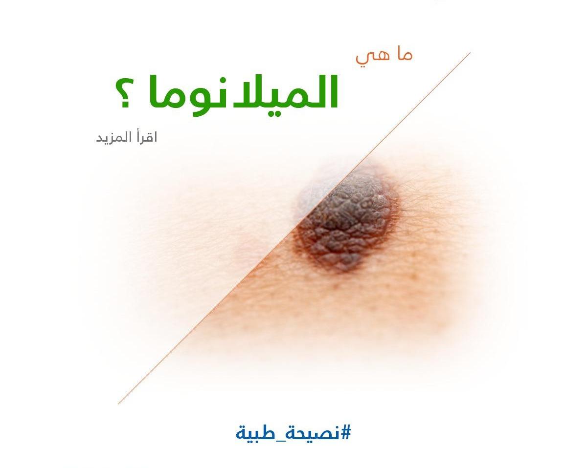ما هي الميلانوما ؟