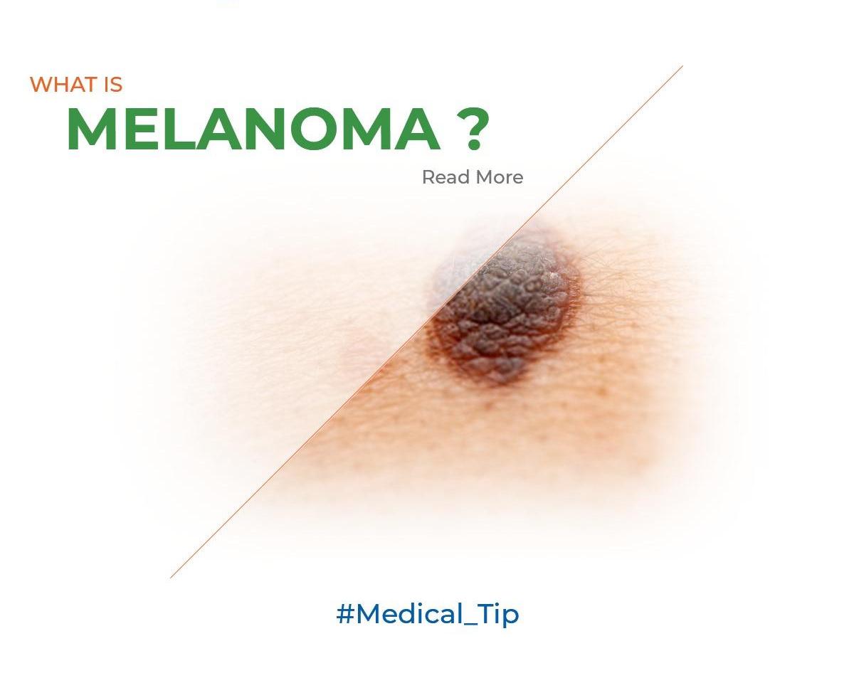 What is melanoma?