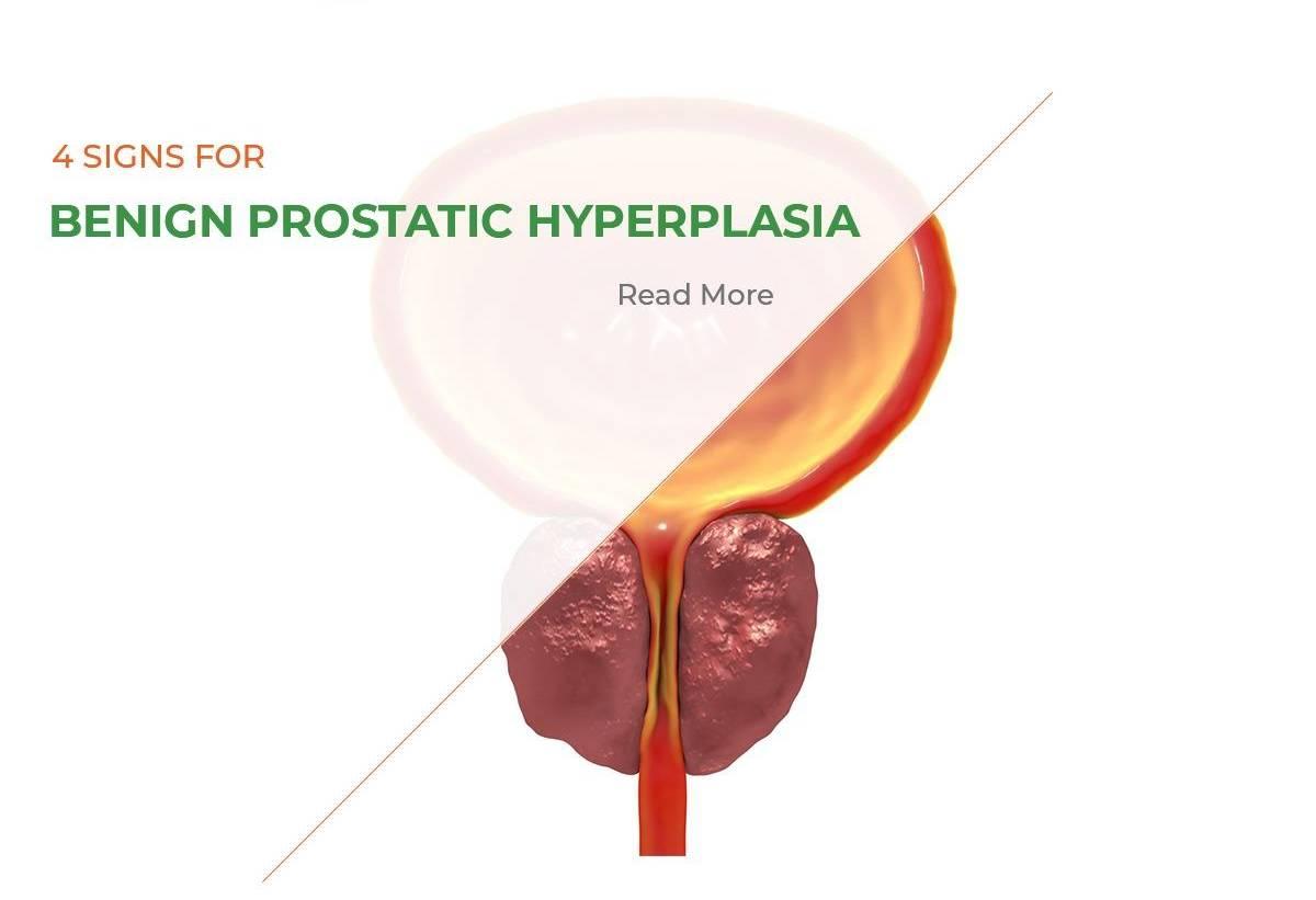4 Signs for benign prostatic hyperplasia