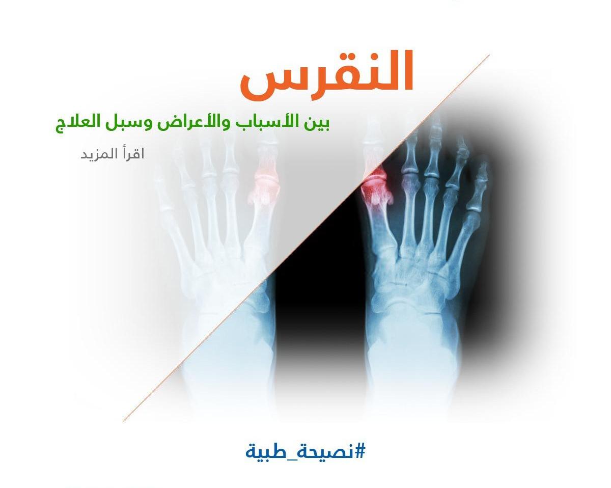 النقرس بين الأسباب والأعراض وسبل العلاج