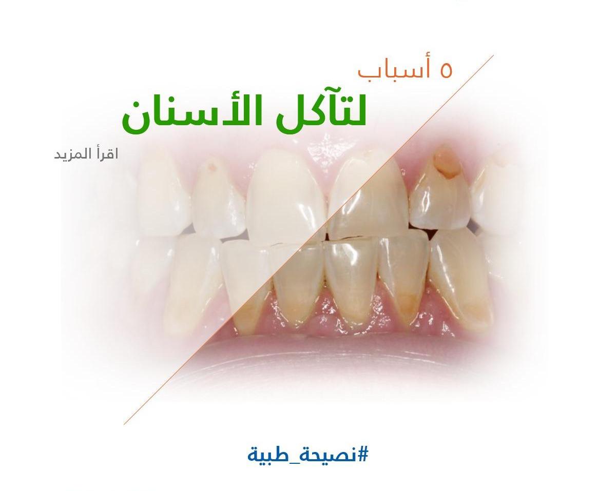 5 أسباب لتآكل الأسنان