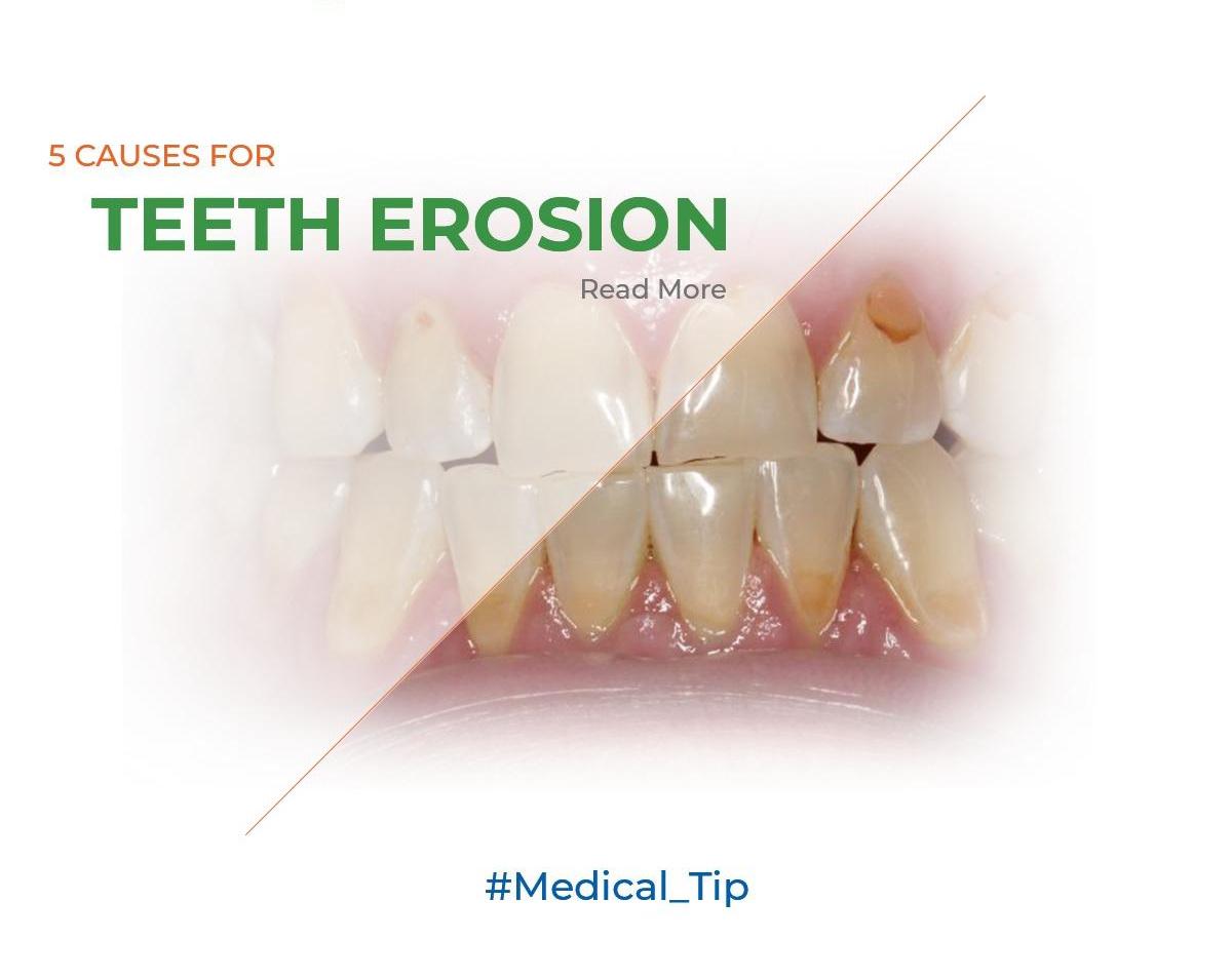 5 Causes for teeth erosion