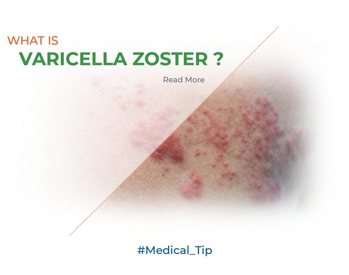 What is varicella zoster?