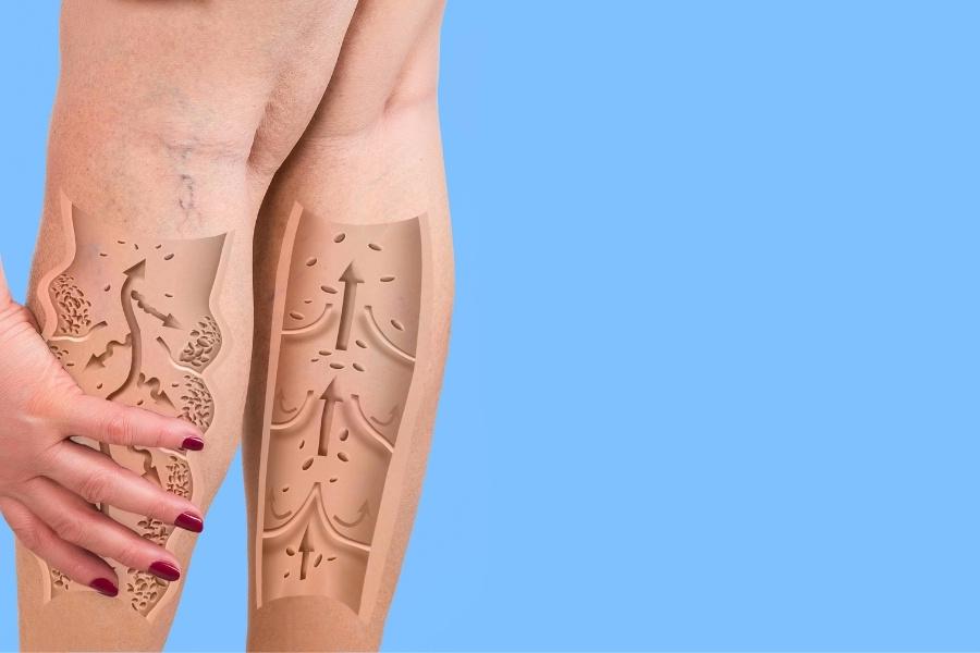 علاج دوالي الساقين